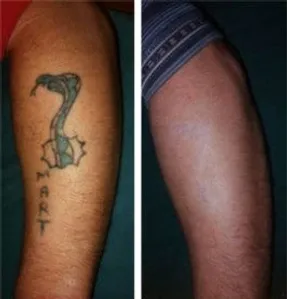 tattoo_removal-2-266x300